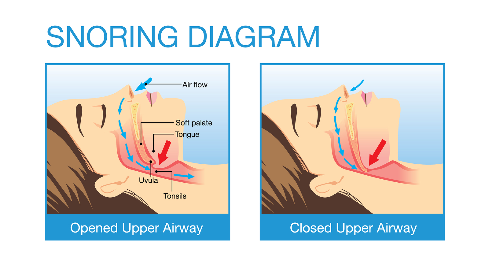 Anatomy of human airway while snoring – North State Sleep Center